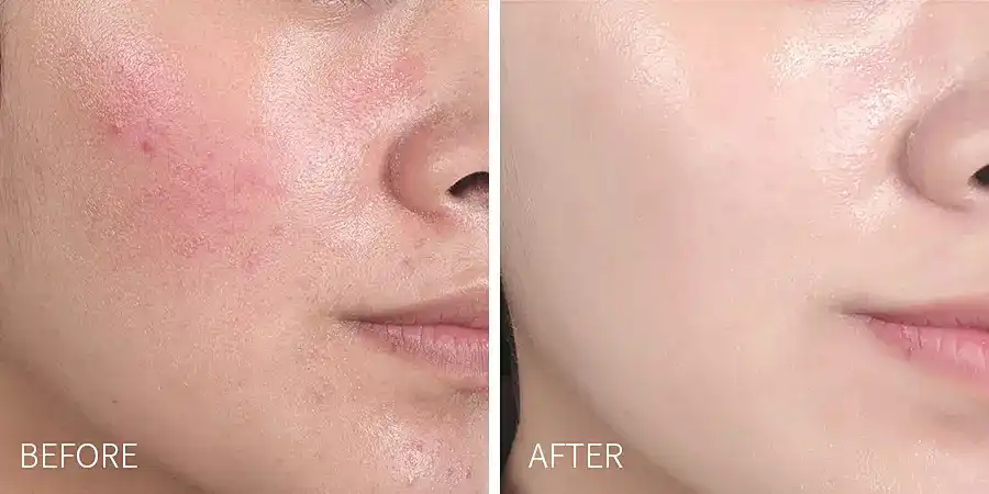 Salicylic Acid Pure Powder