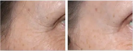 Palmitoyl Tripeptide-5 Palmitoyl Tripeptide-5