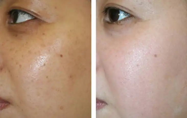 Glycyrrhetinic acid Glycyrrhetinic acid