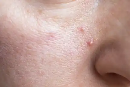 Zinc Pyrithione Zinc Pyrithione