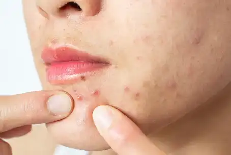 Zinc Pyrithione Zinc Pyrithione