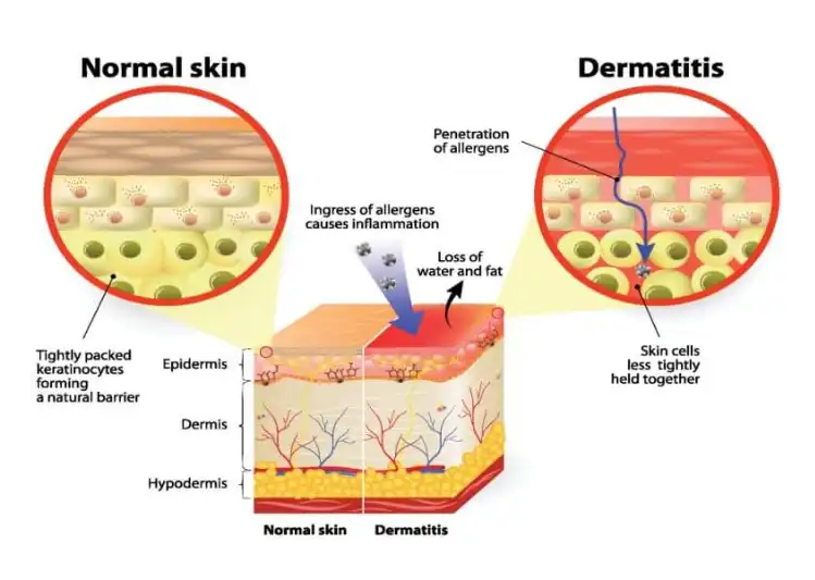 Clobetasol Propionate Powder Clobetasol Propionate Powder
