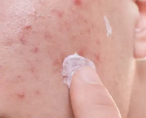Niacinamide