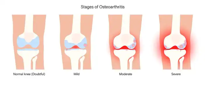 Bulk Avocado Soybean Unsaponifiables Bulk Avocado Soybean Unsaponifiables