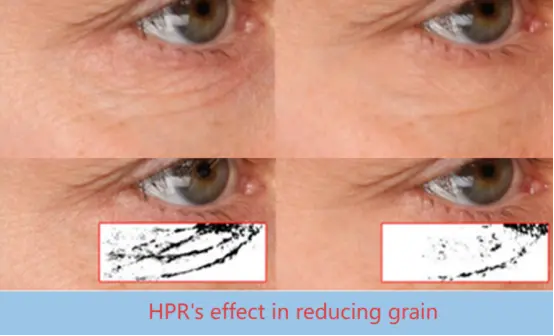 HPR Hydroxypinacolone Retinoate