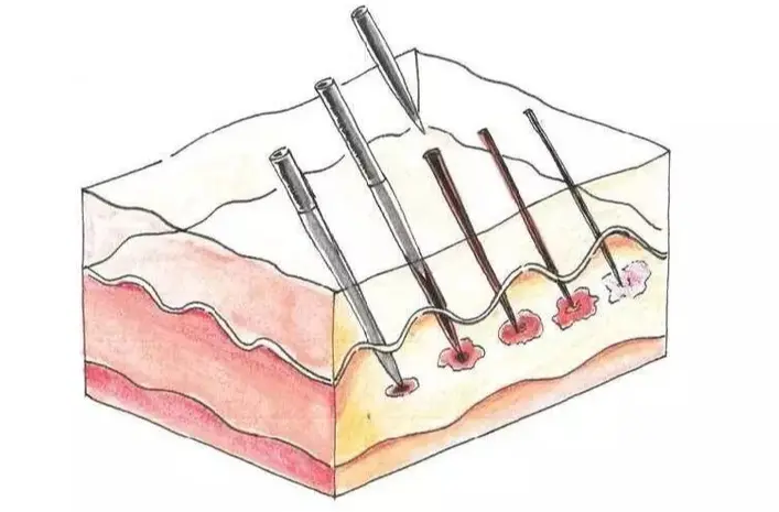 Hydrolyzed Sponge Spicules