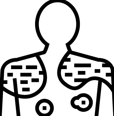Psoriasis Psoriasis