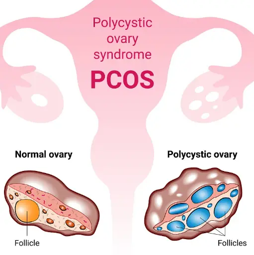 PCOS PCOS