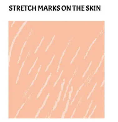 stretch marks stretch marks