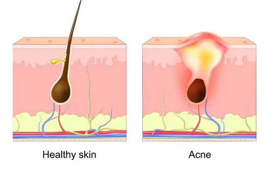 Acne skin Acne skin